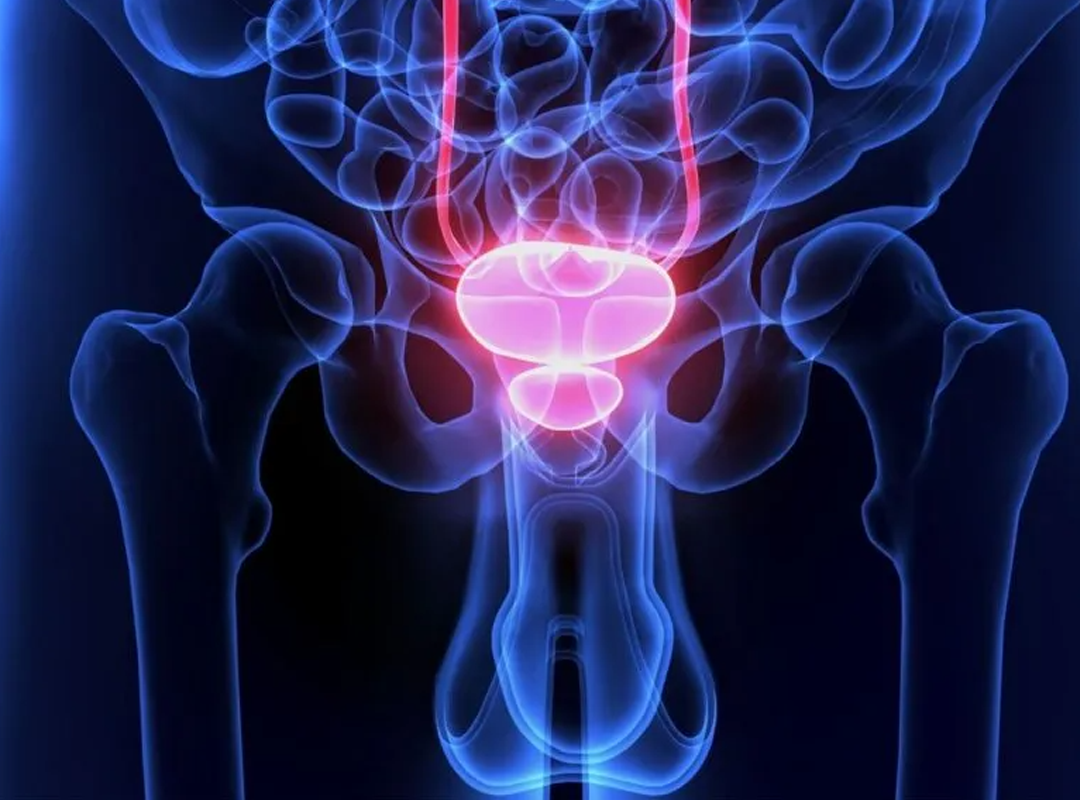 Hiperplasia Prostática Benigna: Crecimiento Prostático