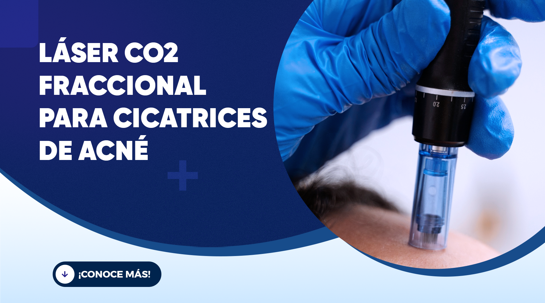 Láser CO₂ para cicatrices de acné