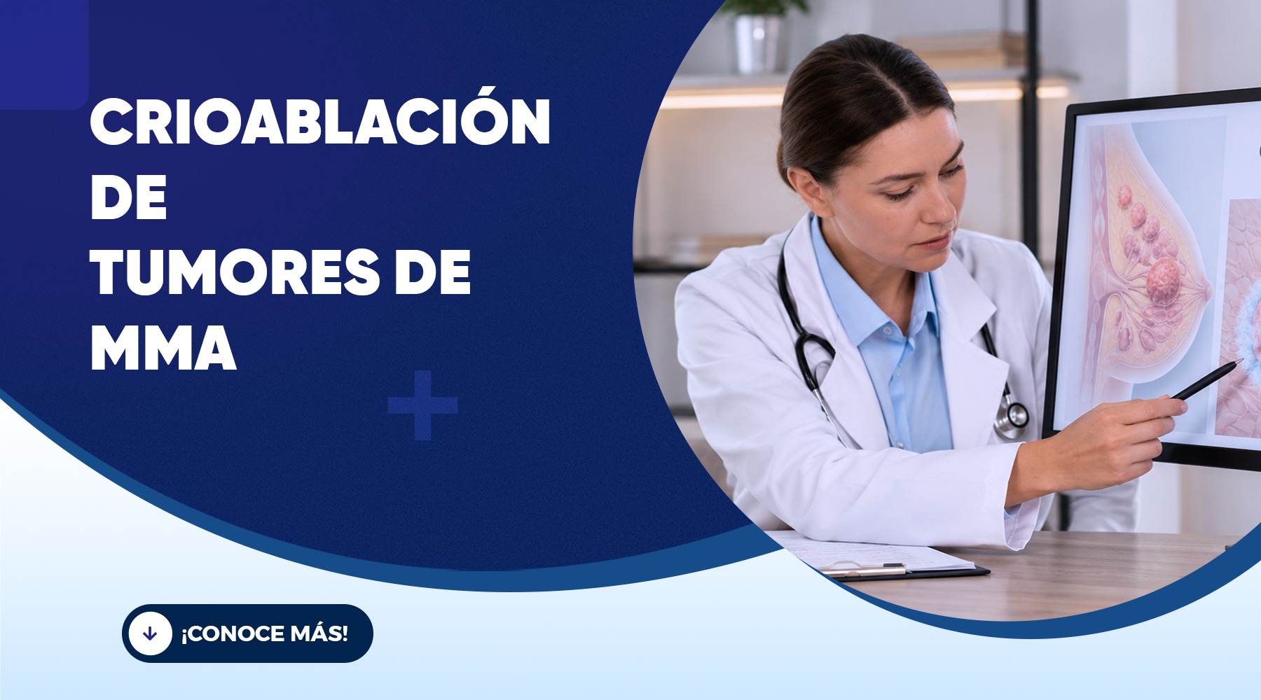 Crioablación de tumores de mama