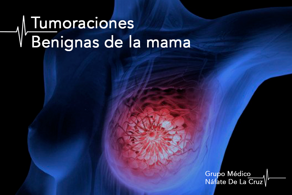 tumoraciones benignas de la mama